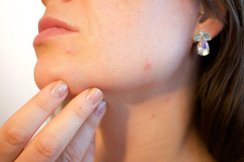 Pielęgnacja skóry trądzikowej – na jakie składniki i kosmetyki zwrócić uwagę?